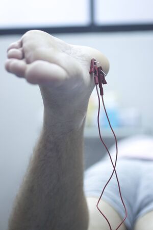 EPI Intratissue Percutaneous Electrolysis dry needling physical therapy medical treatment.の写真素材