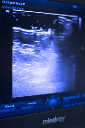 EPI Intratissue Percutaneous Electrolysis dry needling ultrasound ecography scan  physiotherapy medical treatment.の写真素材
