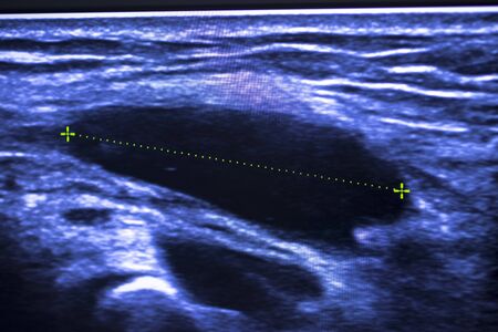 EPI Intratissue Percutaneous Electrolysis dry needling ultrasound ecography scan  physiotherapy...