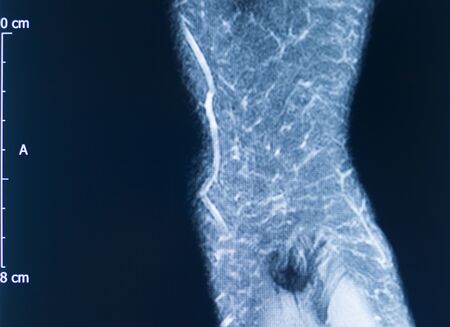 Knee sports injury mri mcl grade 2 tear magnetic resonance imaging orthopedic traumatology scan.