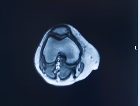 Knee sports injury mri mcl grade 2 tear magnetic resonance imaging orthopedic traumatology scan.の写真素材