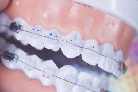 Modern metal retainers and plastic algners wire dental brackets teeth straighteners.
