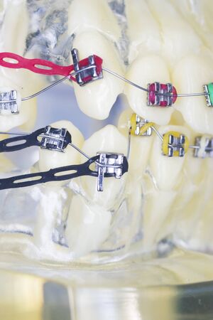 Modern metal retainers and plastic algners wire dental brackets teeth straighteners.の写真素材