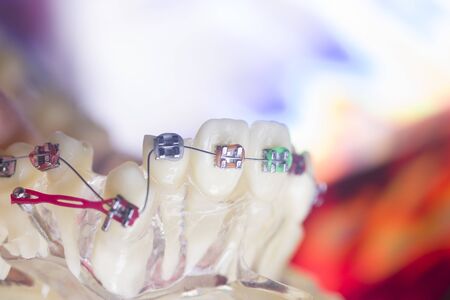 Modern metal retainers and plastic algners wire dental brackets teeth straighteners.