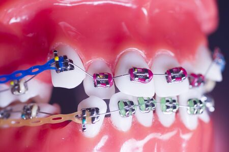 Modern metal retainers and plastic algners wire dental brackets teeth straighteners.