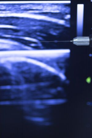 EPI Intratissue Percutaneous Electrolysis dry needling ultrasound ecography scan  physiotherapy...