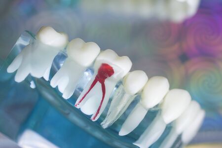 Dentists perfect white teeth teaching dental plastic model with tooth decay and roots canal.