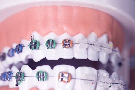 Modern metal retainers and plastic algners wire dental brackets teeth straighteners.の写真素材