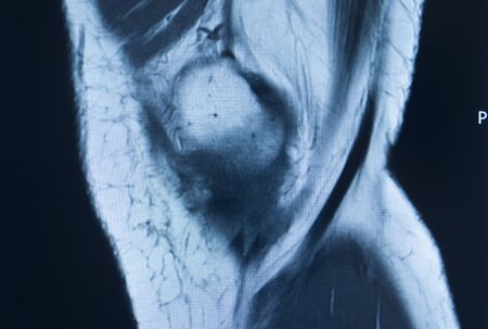 Knee sports injury mri mcl grade 2 tear magnetic resonance imaging orthopedic traumatology scan.の写真素材