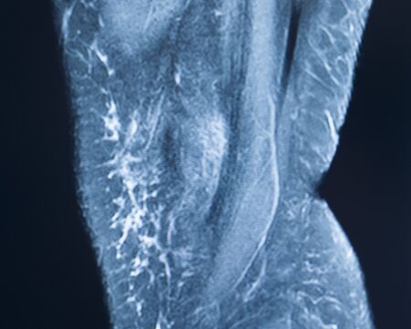 Knee sports injury mri mcl grade 2 tear magnetic resonance imaging orthopedic traumatology scan.