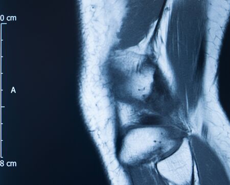 Knee sports injury mri mcl grade 2 tear magnetic resonance imaging orthopedic traumatology scan.