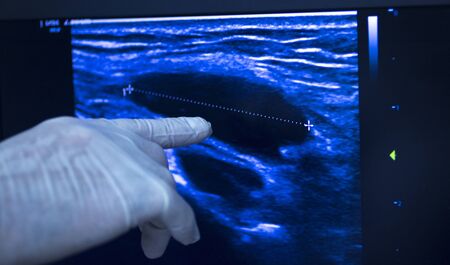 EPI Intratissue Percutaneous Electrolysis dry needling ultrasound ecography scan  physiotherapy medical treatment.の写真素材