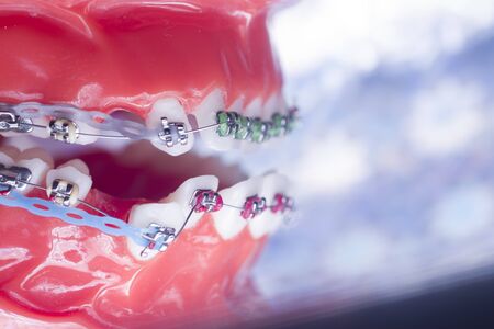 Modern metal retainers and plastic algners wire dental brackets teeth straighteners.