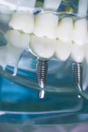 Dentists perfect white teeth teaching dental plastic model with titanium implant.