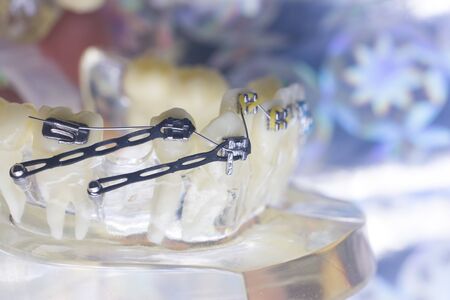 Modern metal retainers and plastic algners wire dental brackets teeth straighteners.の写真素材