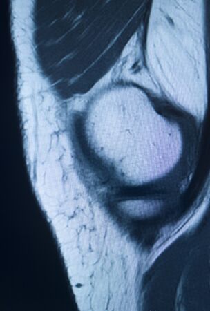 Knee sports injury mri mcl grade 2 tear magnetic resonance imaging orthopedic traumatology scan.の写真素材