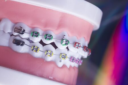Modern metal retainers and plastic algners wire dental brackets teeth straighteners.の写真素材