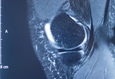 Knee sports injury mri mcl grade 2 tear magnetic resonance imaging orthopedic traumatology scan.