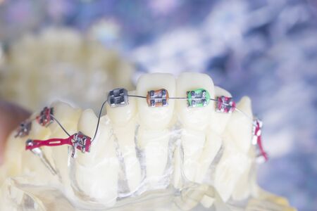 Modern metal retainers and plastic algners wire dental brackets teeth straighteners.