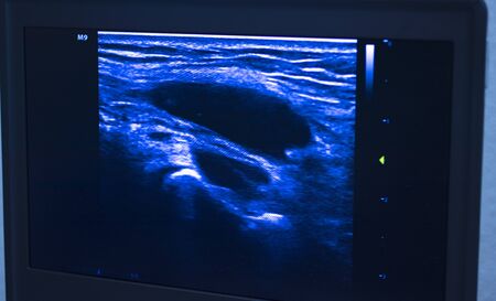 EPI Intratissue Percutaneous Electrolysis dry needling ultrasound ecography scan  physiotherapy...
