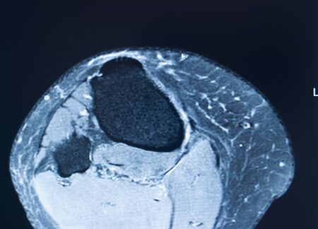 Knee sports injury mri mcl grade 2 tear magnetic resonance imaging orthopedic traumatology scan.の写真素材