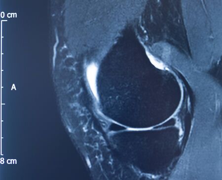 Knee sports injury mri mcl grade 2 tear magnetic resonance imaging orthopedic traumatology scan.の写真素材