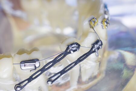 Modern metal retainers and plastic algners wire dental brackets teeth straighteners.の写真素材