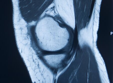 Knee sports injury mri mcl grade 2 tear magnetic resonance imaging orthopedic traumatology scan.の写真素材