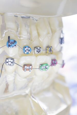 Modern metal retainers and plastic algners wire dental brackets teeth straighteners.の写真素材