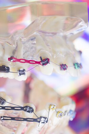 Modern metal retainers and plastic algners wire dental brackets teeth straighteners.の写真素材