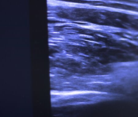 EPI Intratissue Percutaneous Electrolysis dry needling ultrasound ecography scan  physiotherapy...
