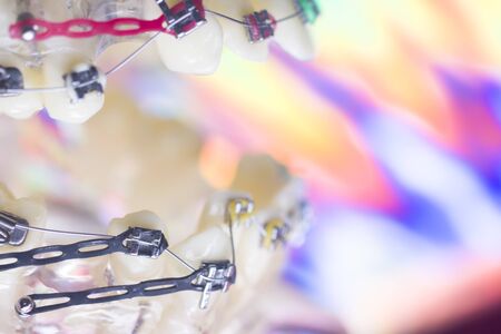 Modern metal retainers and plastic algners wire dental brackets teeth straighteners.の写真素材