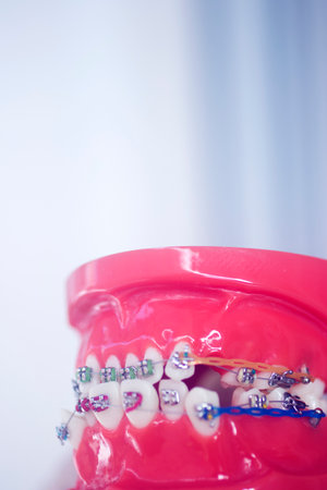 Dental teeth aligner bracket teaching student model showing gums and metal tooth straighteners.