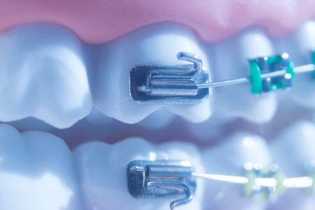 Modern metal brackets aligner straighterners used to correct alignment on teeth by dentists.