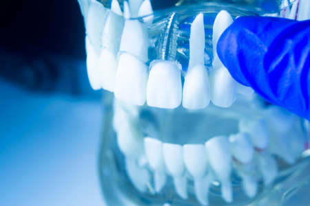 Dental tooth metal implant dentistry teaching model showing teeth and gum.