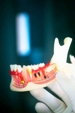 Tooth decay dentists dental model of teeth, gums and root canalの写真素材