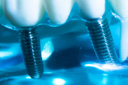Dental tooth metal implant dentistry teaching model showing teeth and gum.