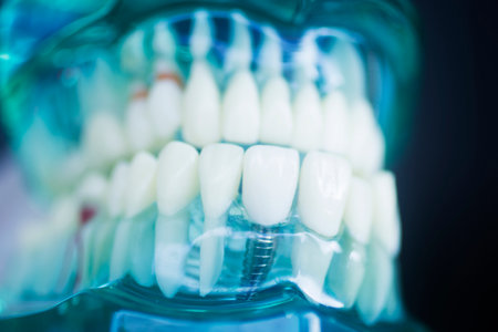 Dental tooth implant titanium prosthetic dentists model.