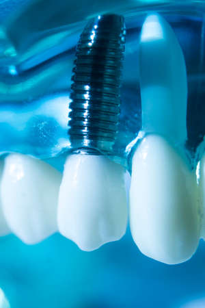 Dental tooth metal implant dentistry teaching model showing teeth and gum.の写真素材