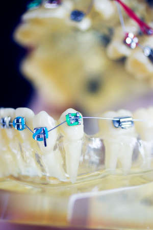 Dental teeth aligner bracket teaching student model showing gums and metal tooth straighteners.の写真素材
