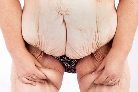 Middle aged woman with sagging skin after babies and extreme weight loss. Inspiration for poster and meme, before brachioplasty, panniculectomy, abdominoplasty and mummy makeover in Australia.の写真素材