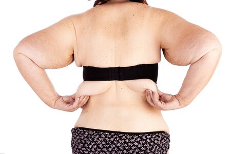 Middle aged woman with sagging skin after babies and extreme weight loss. Inspiration for poster and meme, before brachioplasty, panniculectomy, abdominoplasty and mummy makeover in Australia.の写真素材