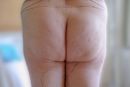 Selective focus of mature women and markings for beltectomy, panniculectomy or apron removal and...