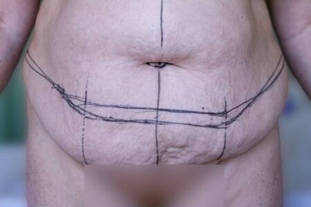 Selective focus of mature women and markings for beltectomy, panniculectomy or apron removal and liposuction on inner thighs. A tummy tuck extending to the spine. Mummy tummy, sagging loose skin.の写真素材