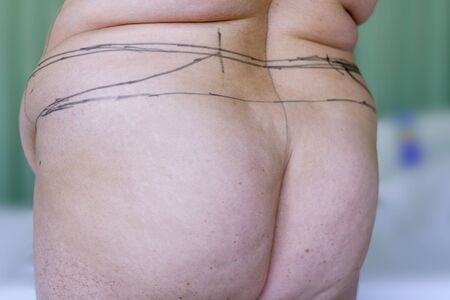 Selective focus of mature women and markings for beltectomy, panniculectomy or apron removal and...