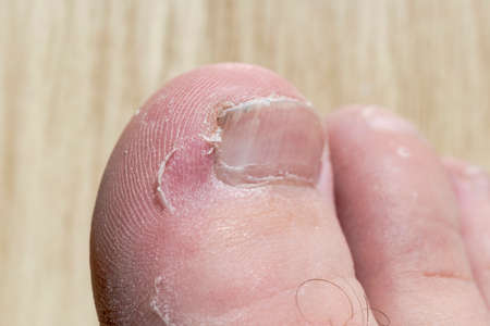 Close up of the toe on a foot of person who has athletes foot skin conditionの写真素材