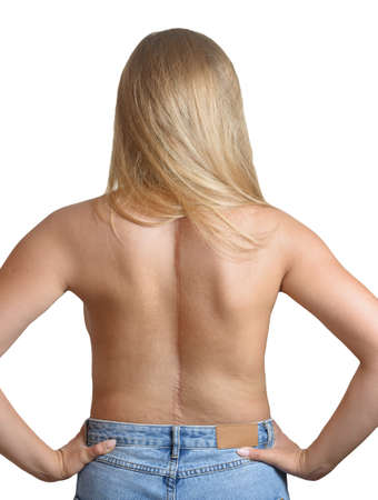 Young woman with scars from spinal surgery.の写真素材