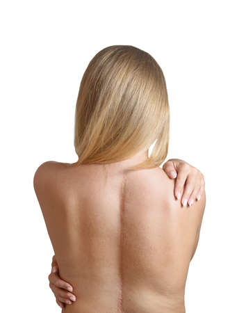 Young woman with scars from spinal surgery.の写真素材