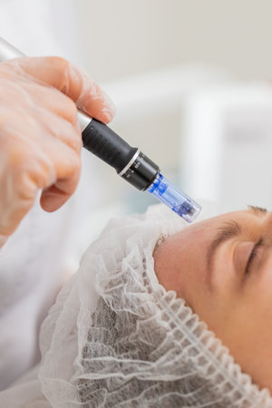 Peeling, woman health care, skin regeneration, dermapen microneedling, dermastamp. Beautician...