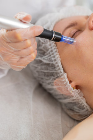 Peeling, woman health care, skin regeneration, dermapen microneedling, dermastamp. Beautician...